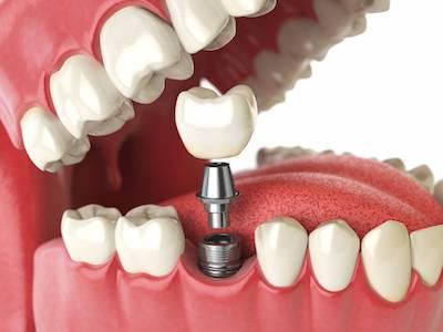 dental implants san jose