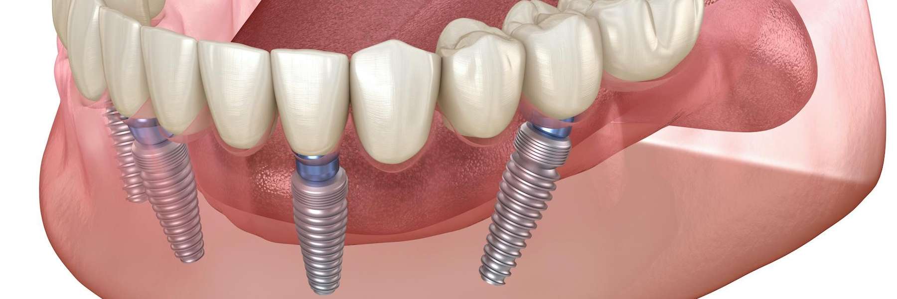 implanted dentures san jose 